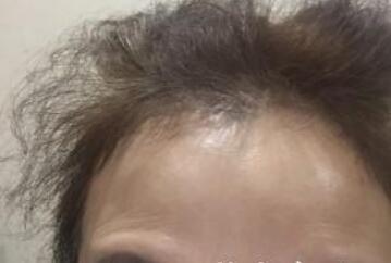 去抬頭紋很好的方法？注射瘦臉去抬頭紋魚尾紋