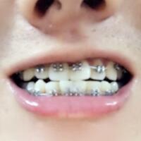 牙齒排列不整齊，在成都圣貝牙科醫(yī)院做了牙齒正畸矯正緩解