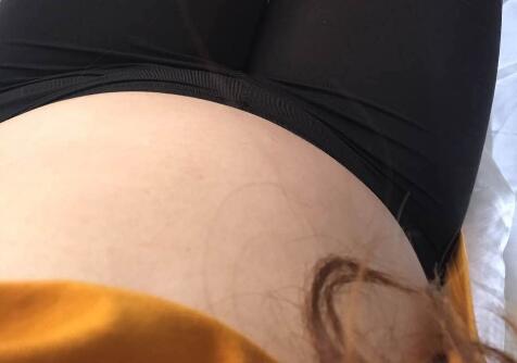抽脂減肥瘦腰腹手術價格1.3w真實案例前后對比圖