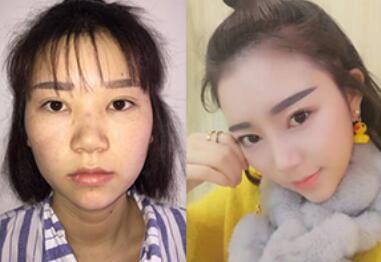 隆鼻圖片，隆鼻有哪幾種方式?多少錢?隆鼻價格受什么因素影響?