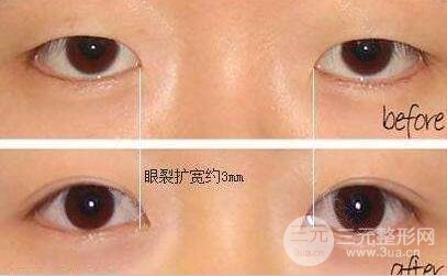 開眼角和雙眼皮可以一起做嗎？