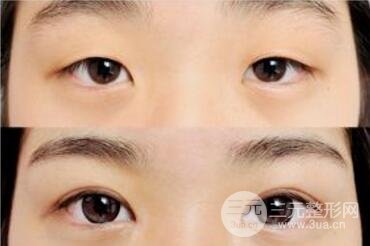 什么季節(jié)割雙眼皮比較好?