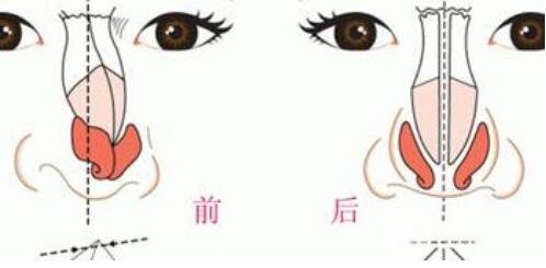 歪鼻矯正的手術(shù)是怎么做的？