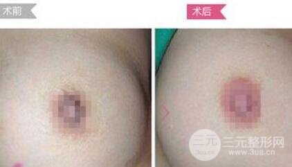乳暈漂紅降低風(fēng)險(xiǎn)嗎?乳暈漂紅有果嗎?