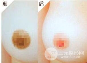乳暈漂紅術(shù)后會(huì)浮腫嗎?