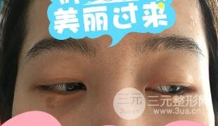 真人內(nèi)切去眼袋手術(shù)過(guò)程對(duì)比圖片和案例分享