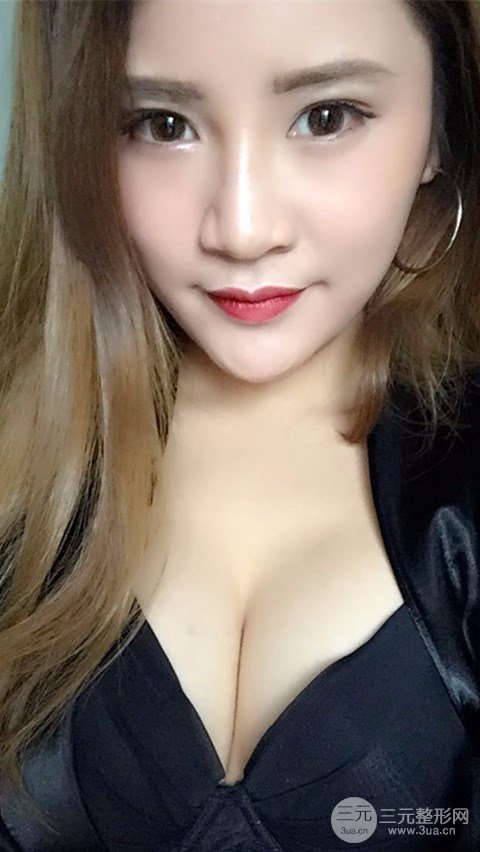 淄博陽光整形自體脂肪隆胸前后對比圖，真實案例