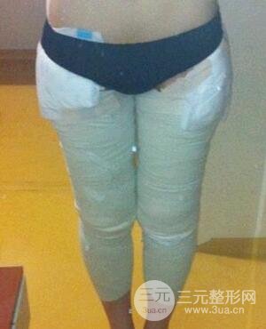 河南鄭州大腿吸脂的真實(shí)案例,前后對(duì)比果圖