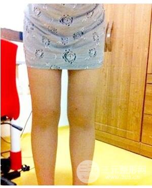河南鄭州大腿吸脂的真實(shí)案例,前后對(duì)比果圖