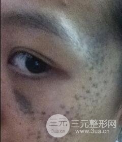 南寧緩解的太田痣真實(shí)案例,前后果對(duì)比圖