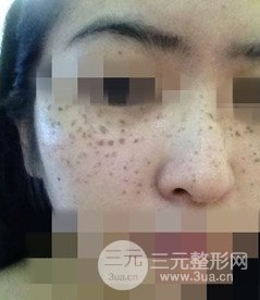 激光祛斑的恢復(fù)過程，逐步見證自己顏值的逐步提升。