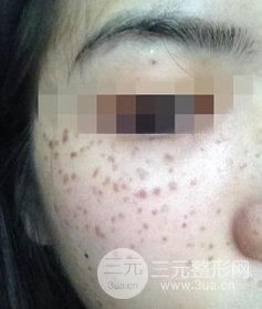 激光祛斑的恢復(fù)過程，逐步見證自己顏值的逐步提升。