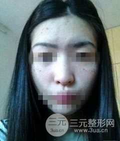 激光祛斑的恢復(fù)過程，逐步見證自己顏值的逐步提升。