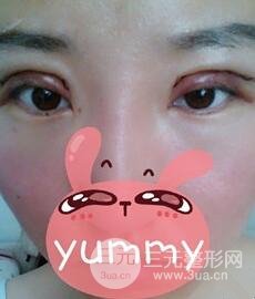北京全切雙眼皮手術(shù)真實(shí)案例，果對(duì)比圖
