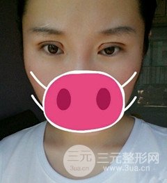 北京全切雙眼皮手術(shù)真實(shí)案例，果對(duì)比圖