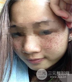 面部美白容整形激光祛斑手術(shù)恢復過程