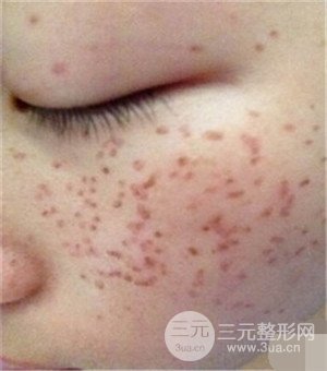 面部美白容整形激光祛斑手術(shù)恢復過程