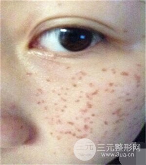 面部美白容整形激光祛斑手術(shù)恢復過程