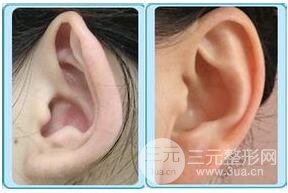 招風(fēng)耳矯正好不好?會不會留疤?