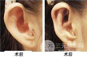 招風(fēng)耳矯正好不好?會不會留疤?