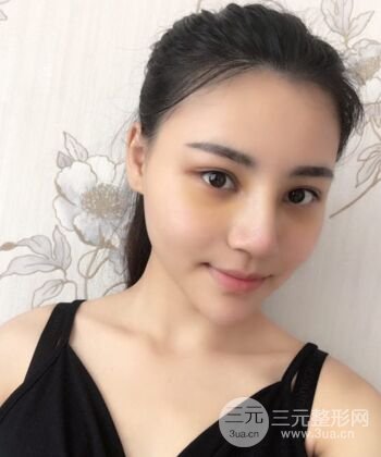 在漢中韓美做了隆鼻整形一個(gè)月，恢復(fù)越來(lái)越自然了