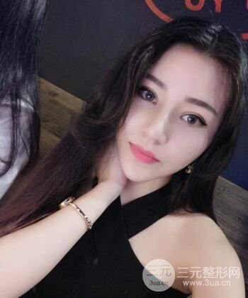 在漢中韓美做了隆鼻整形一個(gè)月，恢復(fù)越來(lái)越自然了