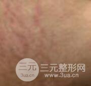 果酸換膚去妊娠紋真人案例和妊娠紋整形手術前后對比圖