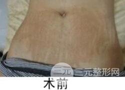 如何去除妊娠紋？做了果酸換膚去妊娠紋果不錯，真人案例圖片分享