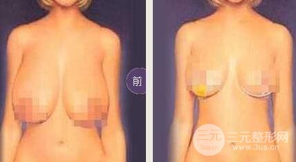 巨大乳房縮小多少錢？成好嗎?巨大乳房縮小對比圖