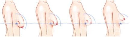 巨大乳房縮小多少錢？成好嗎?巨大乳房縮小對比圖