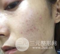 水光補(bǔ)水嫩膚果圖前后對(duì)比和恢復(fù)過(guò)程真實(shí)案例分享