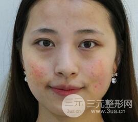 痘坑痘疤要怎么修復(fù)？果酸換膚后臉果圖和真實(shí)案例分享