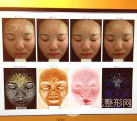 痘坑痘疤要怎么修復(fù)？果酸換膚后臉果圖和真實案例分享