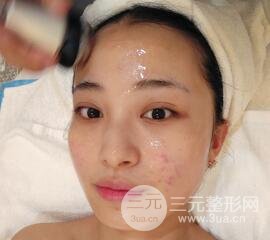 痘坑痘疤要怎么修復(fù)？果酸換膚后臉果圖和真實案例分享