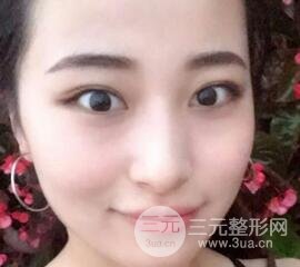 痘坑痘疤要怎么修復(fù)？果酸換膚后臉果圖和真實案例分享
