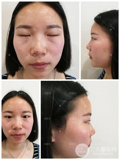 武漢卓美吳秀英雙眼皮+開眼角一個(gè)月恢復(fù)對比照片分享~