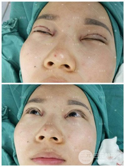 武漢卓美吳秀英雙眼皮+開眼角一個(gè)月恢復(fù)對(duì)比照片分享~