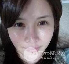我做了光子嫩膚幾天起而且價(jià)格便宜前后對(duì)比照片案例