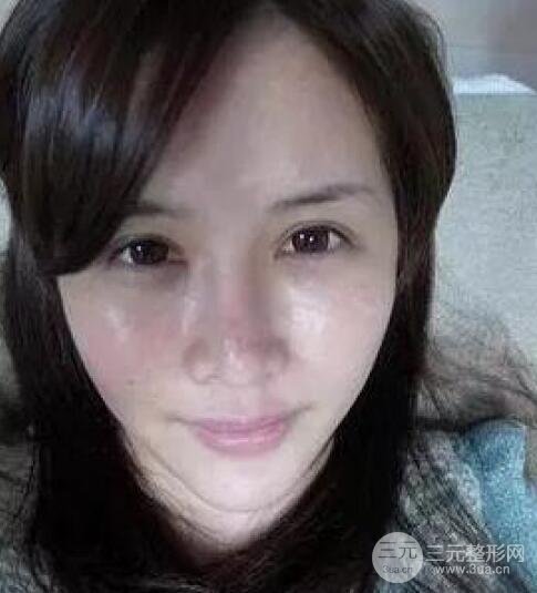 我做了光子嫩膚幾天起而且價(jià)格便宜前后對(duì)比照片案例