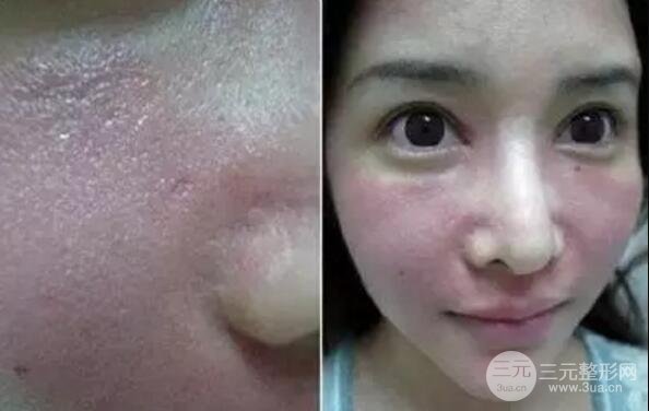 我做了光子嫩膚幾天起而且價(jià)格便宜前后對(duì)比照片案例