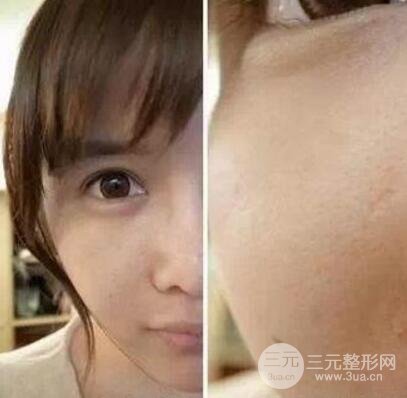 我做了光子嫩膚幾天起而且價(jià)格便宜前后對(duì)比照片案例
