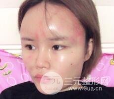 全臉脂肪填充價(jià)格 恢復(fù)過程圖 真實(shí)案例分享