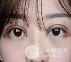 腫泡眼單眼皮變雙眼皮真實切開雙眼皮案例和對比圖