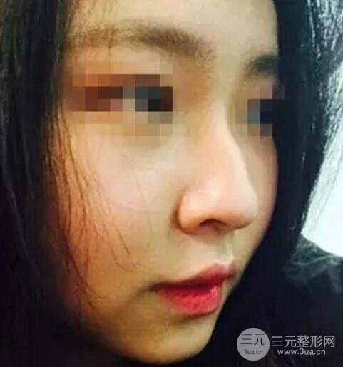 鼻子整形之駝峰鼻矯正價格和前后對比圖 真人案例