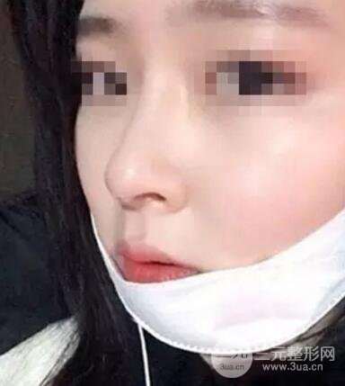 鼻子整形之駝峰鼻矯正價格和前后對比圖 真人案例