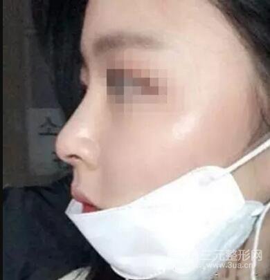 鼻子整形之駝峰鼻矯正價格和前后對比圖 真人案例
