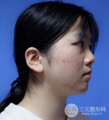 怎樣減掉雙下巴？雙下巴吸脂后個人經(jīng)歷 價格略貴但果好
