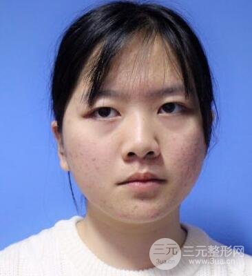 怎樣減掉雙下巴？雙下巴吸脂后個人經(jīng)歷 價格略貴但果好