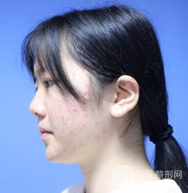 怎樣減掉雙下巴？雙下巴吸脂后個人經(jīng)歷 價格略貴但果好