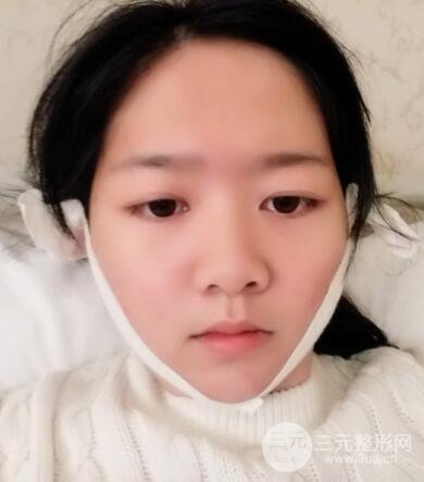 怎樣減掉雙下巴？雙下巴吸脂后個人經(jīng)歷 價格略貴但果好